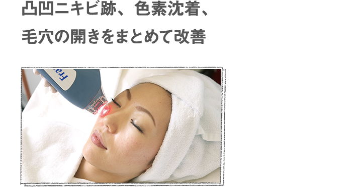 凸凹ニキビ跡、色素沈着、毛穴の開きをまとめて改善