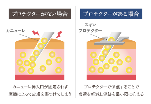 専用ツールで傷跡を少なく